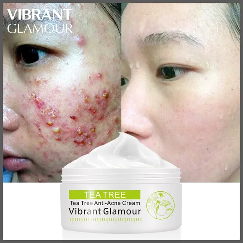 VIBRANT GLAMOUR Tea Tree Acne Cream Anti-acne Print Face Cream Remover Acne  Treatment Facial Eliminates Oil Control Skin Care