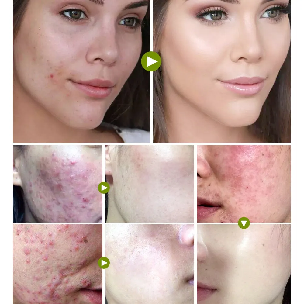 VIBRANT GLAMOUR Tea Tree Acne Cream Anti-acne Print Face Cream Remover Acne  Treatment Facial Eliminates Oil Control Skin Care